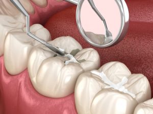 root canal tooth cracked cavities