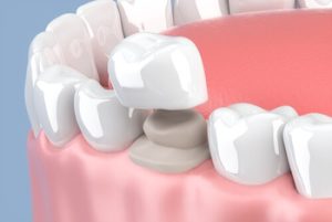 broken crown tooth solution coopers plain