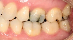 Are Chipped Teeth Common crack