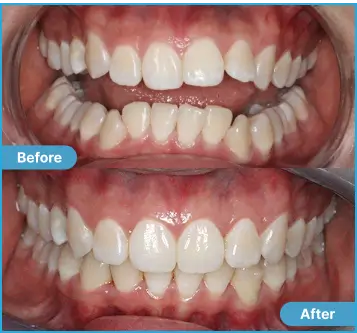 Damien Before After Case 1 Case #1 Damien: Side-by-side comparison of teeth before and after dental treatment.
