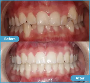Helena Before After Case 2 Case #2 Helena: Side-by-side comparison of teeth before and after dental treatment.