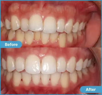 Nadia Before After Case 3 Case #3 Nadia: Side-by-side comparison of teeth before and after dental treatment.
