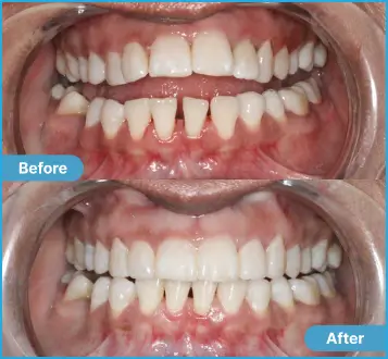 Sakshi Before After Case 4 Case #4 Sakshi: Side-by-side comparison of teeth before and after dental treatment.