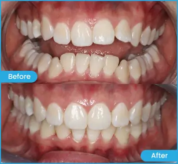 Sure Smile Damien Clear Aligners
