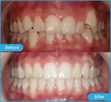 Sure Smile Helena Clear Aligners