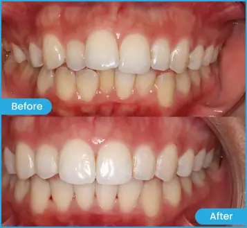 Sure Smile Nadia Clear Aligners