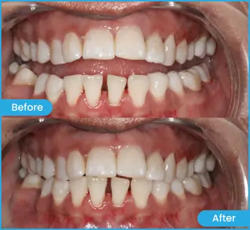 Sure Smile Sakshi Clear Aligners