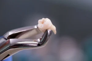 tooth after extraction recovery